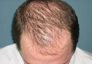 causas da perda de cabelo