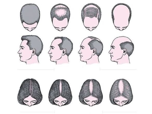 Alopecia androxenética en homes e mulleres
