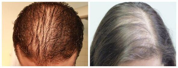 Alopecia difusa