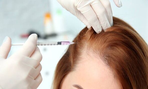 Mesoterapia para a calvicie