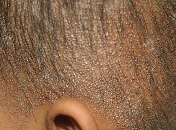 Mucinose folicular