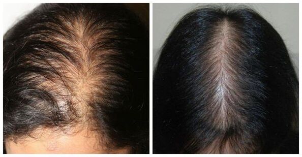Perda de cabelo nas mulleres