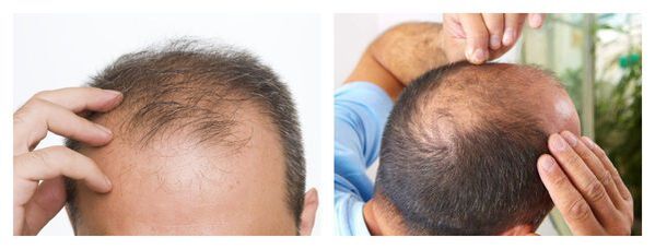 Perda de cabelo nos homes
