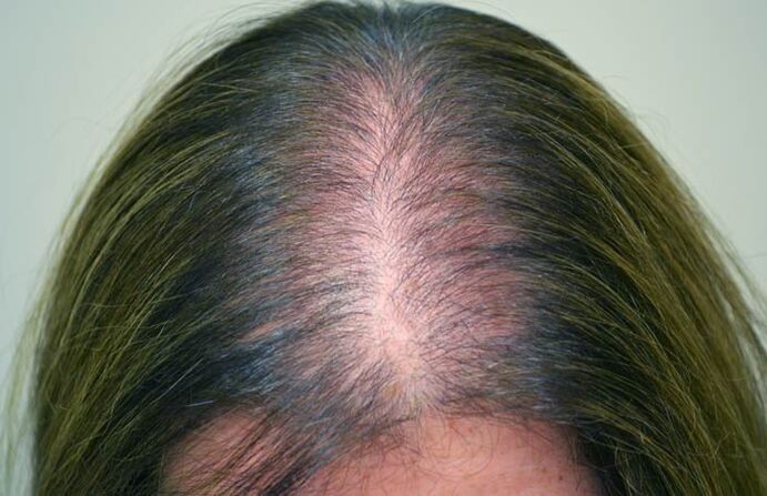 Alopecia (calvicie) nas mulleres