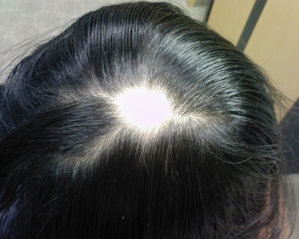 Alopecia areata ou alopecia areata en mulleres