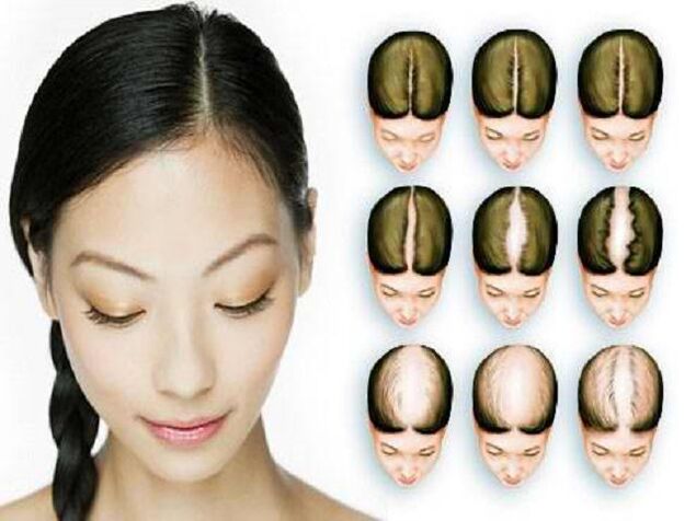 Etapas da alopecia nas mulleres