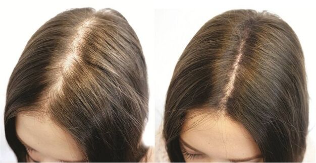 O resultado do tratamento oportuno da alopecia nas mulleres