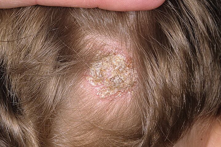 Tipo de alopecia seborreica en mulleres