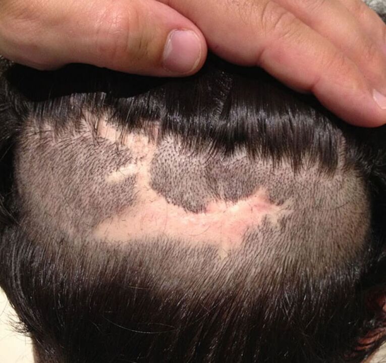 alopecia cicatricial do coiro cabeludo