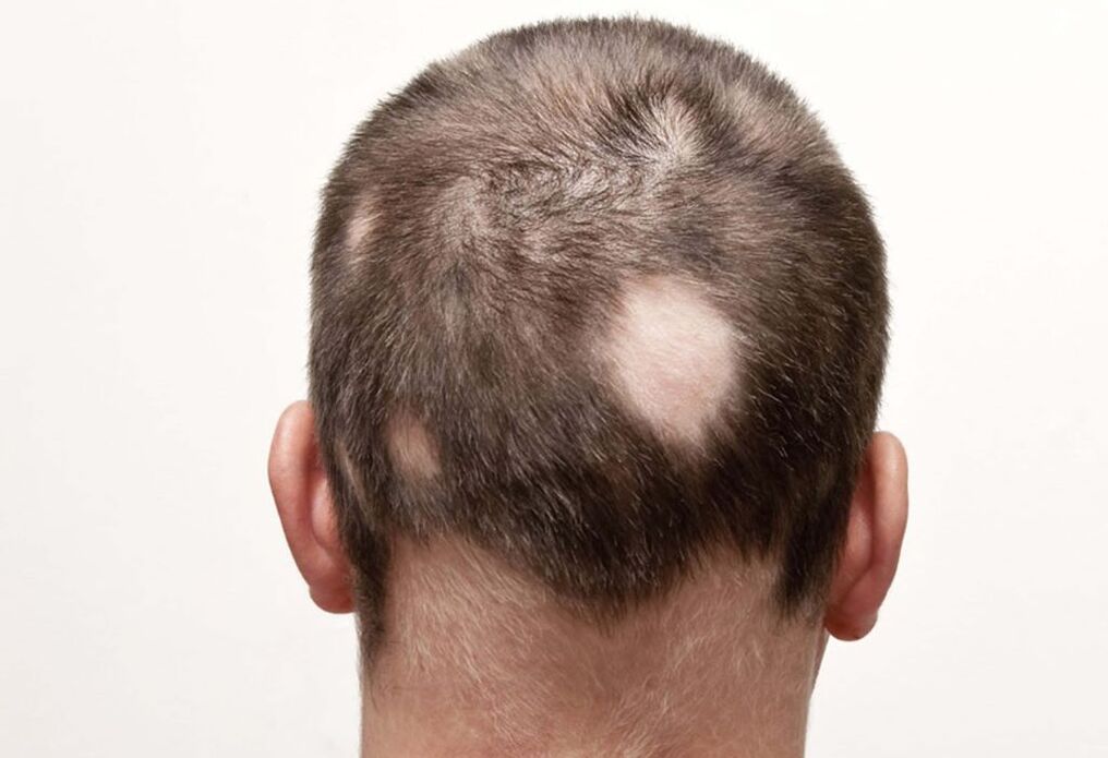 alopecia de nidificación (focal) da cabeza