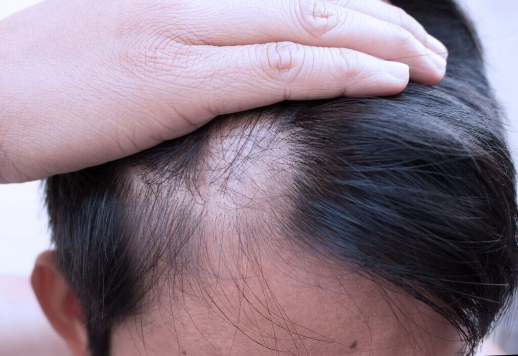 alopecia difusa da cabeza