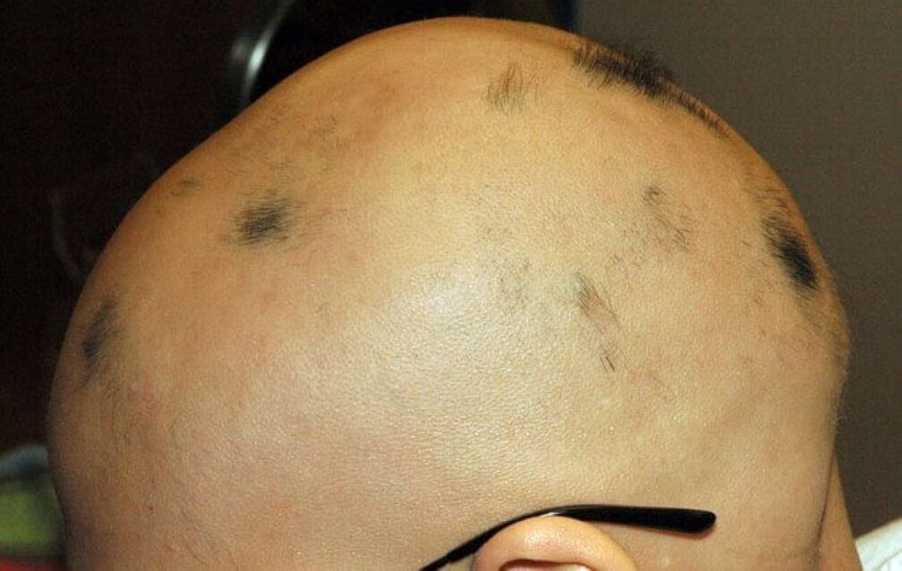 alopecia total do coiro cabeludo nun home