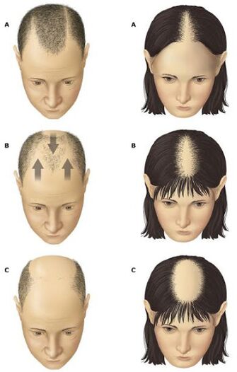 Alopecia andróxena en homes e mulleres