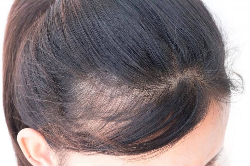Alopecia andróxena en mulleres