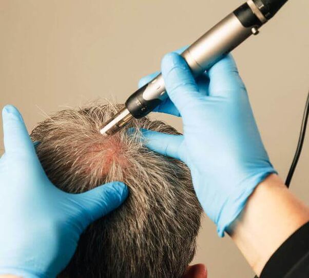 Fisioterapia para o tratamento da alopecia andróxena