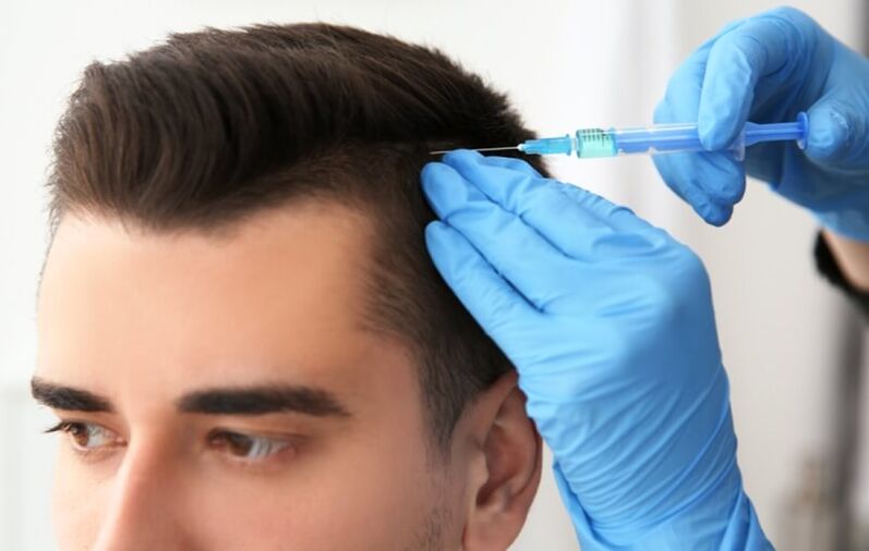 Mesoterapia para estimular o crecemento capilar na alopecia andróxena