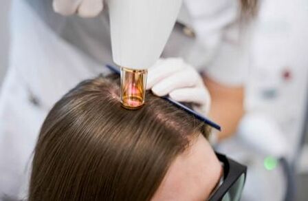 Terapia con láser para a alopecia androxenética